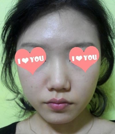 小女子隆鼻一個月^-^附術(shù)后詳細(xì)照片^-^從丑鬼到美女的轉(zhuǎn)變…