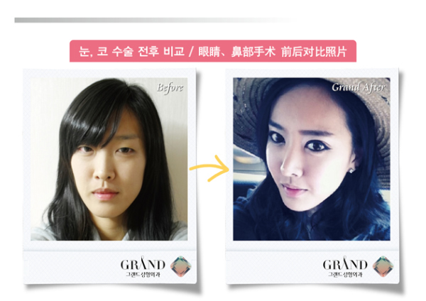 [高蘭得整形外科]眼睛，鼻子前后照片2
