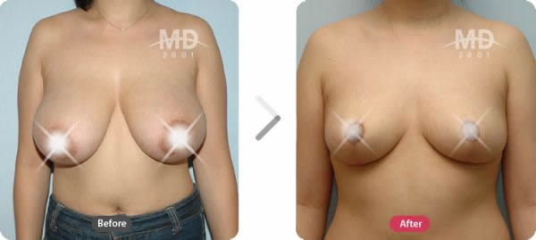 韓國MD整形外科巨乳縮小+乳暈改小對比案例 