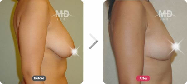 韓國MD整形外科乳房下垂懸吊術(shù)對比案例