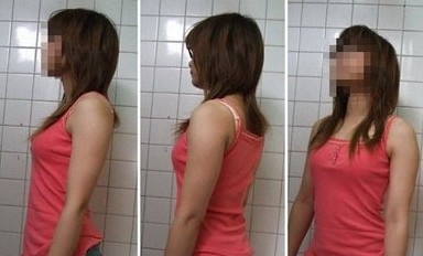 我做手臂吸脂的過程和一點經(jīng)驗~
