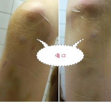 我做手臂吸脂的過程和一點經(jīng)驗~