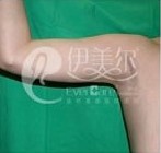 手臂吸脂手術(shù)前后對比圖