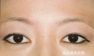 祛紋眉