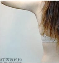 手臂聚能緊致溶脂減肥前后對比照