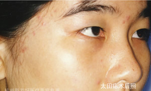 太田痣