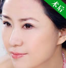 軍美整形案例：面部填充