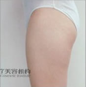 臀部/大腿聚能緊致溶脂減肥前后對比照