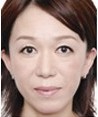激光去皺案例對比圖