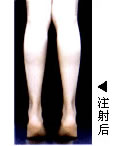 白領(lǐng)親身體驗仁愛微創(chuàng)瘦小腿