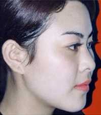 隆鼻前后對比圖