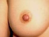 乳頭矯正手術(shù)案例