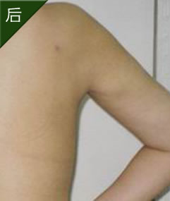 水動力吸脂前后對比