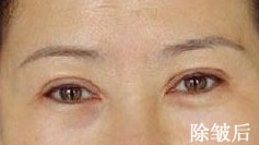 膠原蛋白除皺前后對(duì)比圖