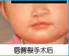 唇腭裂治療前后對比