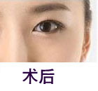 北京清木整形眼部手術(shù)
