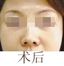 北京清木除皺前后對(duì)比