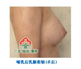 產(chǎn)后豐胸手術(shù)前后對比圖