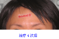 額部痤瘡治療前后