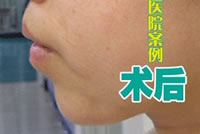 隆下巴手術(shù)前后對(duì)比圖