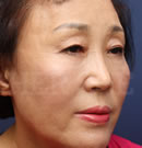 移植除皺手術(shù)對比案例