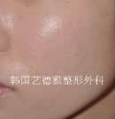 注射自體脂肪移植配合激光治療痘痕前后對比