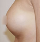 果凍義乳隆胸整形前后對比照片