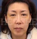 面部提升除皺術(shù)前后對比照片