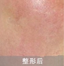 激光去紅血絲對比案例