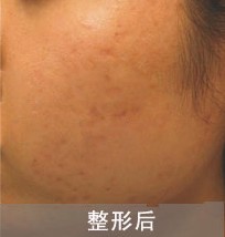 激光祛痘對比案例