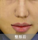 豐唇手術(shù)對比手術(shù)案例