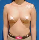 韓國MD整形外科乳房下垂矯正+乳暈縮小+巨乳縮小對比案例