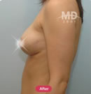 韓國MD整形外科乳房下垂矯正術(shù)對比案例