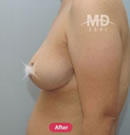 韓國MD整形外科巨乳縮小+乳房下垂矯正對比案例