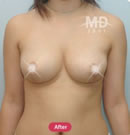 韓國(guó)MD整形外科乳房外擴(kuò)矯正術(shù)對(duì)比案例