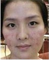 青春痘疤痕治療前后對比