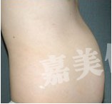 等離子光纖溶脂