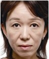 激光去皺案例對比圖