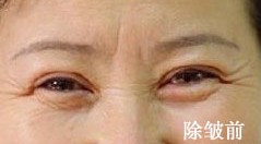 膠原蛋白除皺前后對(duì)比圖