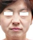 生物除皺前后對比圖