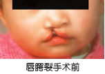 唇腭裂治療前后對比