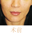 北京清木注射prp自體血清前后