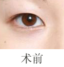 北京清木桃花電眼雙眼皮手術(shù)前后對比