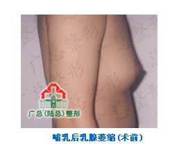 產(chǎn)后豐胸手術(shù)前后對比圖