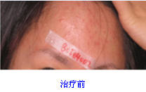 額部痤瘡治療前后