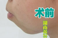 隆下巴手術(shù)前后對(duì)比圖