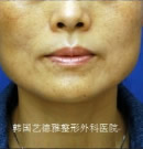 腮骨縮小術前后對比照片