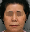 面部抗衰老整形對(duì)比案例