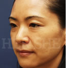 玻尿酸除皺對(duì)比案例