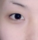 雙眼皮手術前后對比照片